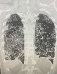 Chest CT Findings in 2019 Novel Coronavirus. Glass opacity, Consolidation, Crazy-paving. Adenovirus pneumonia shows bilateral multifocal GGO with patchy consolidations on CT images