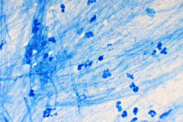 Mycobacterium tuberculosis positive (small red rod) in sputum smear