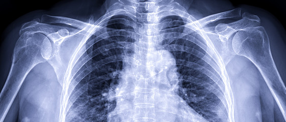 X-ray Shoulder joint shoulder transaxillary view for diagnosis fracture of shoulder joint.