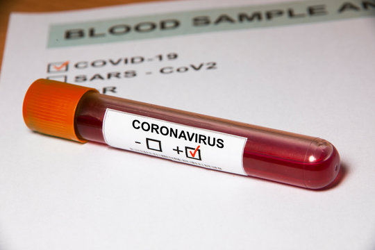Probeta sobre formulario de resultados de análisis de sangre de Coronavirus o Covid19 