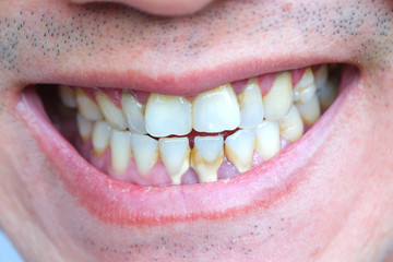 Obraz premium Tooth's a man smoking bad. Man smokes a cigarettes have tooth decay and calculus on teeth, So we should be care dental with the hygiene.soft focus