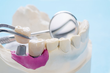 Fototapeta na wymiar Closeup / Implant Prosthodontics or Prosthetic / Tooth crown and bridge implant dentistry equipment and model express fix restoration.