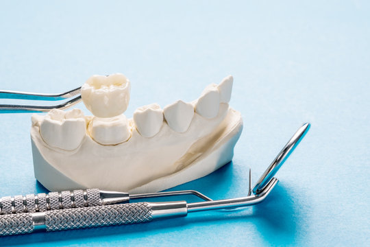 Closeup / Prosthodontics or Prosthetic / Single teeth crown and bridge equipment and model express fix restoration.