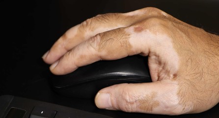 Hand with vitiligo holding a mouse on black background.