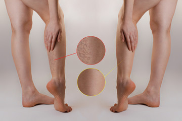 Medicine and health. The concept of female varicose veins. A woman rubs her tired legs with...