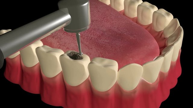 Tooth Cavity Filling Procedure