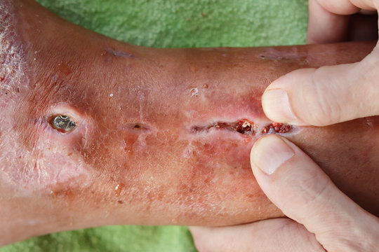 A postoperative wound infection or surgical wound infection on the right foot