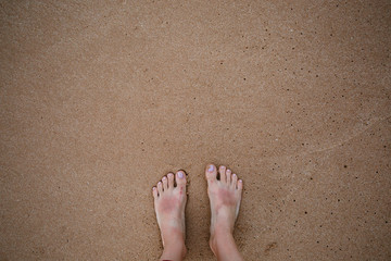 
Burnt feet of a European man on the background of sand on the beach. Consequences of sunburn without using sunscreen