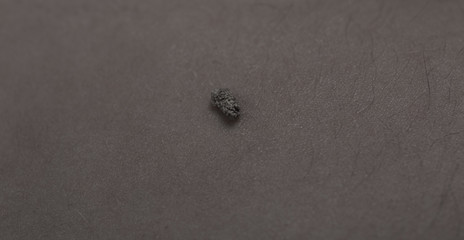5 mm kidney stone laying on naked belly