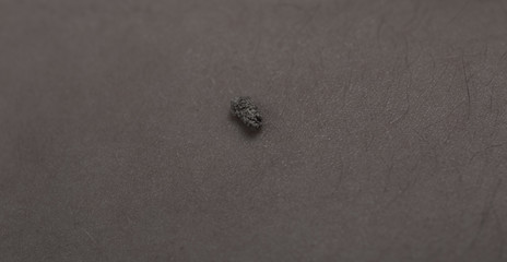 5 mm kidney stone laying on naked belly