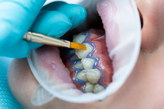 Teeth whitening procedure. Tooth whitening gel. Dentist does the whitening procedure.