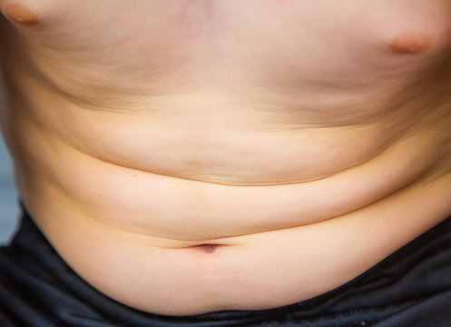 Child's belly showing overweight and early signs of obesity