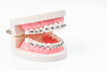 tooth model with metal wire dental braces.