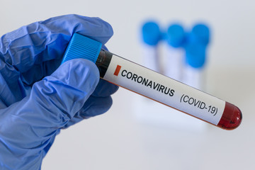 Obraz premium Coronavirus Covid 19 blood sample, SARS CoV 2 virus blood test