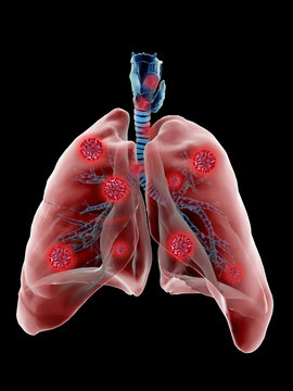 X Ray Lung Model Covid - 19 Corona Pneumonia Disease