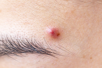 Woman 's problematic skin , acne scars ,oily skin and pore, dark spots and blackhead and whitehead...