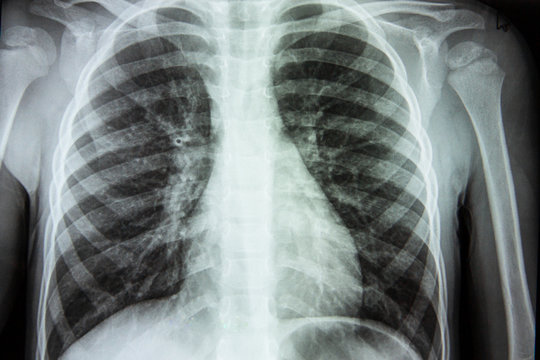 X-ray of a person’s lungs with a disease. Screening for coronavirus viruses