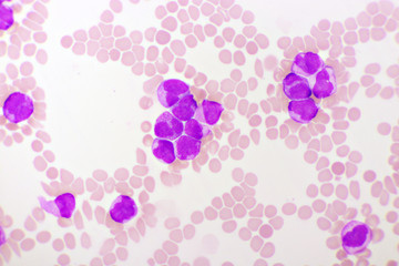 Acute promyelocytic leukemia cells or APL, analyze by microscope, original magnification 1000x