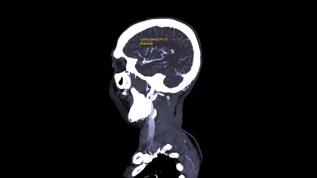 CTA Brain or computed tomography angiography of the brain sagittal mip view showing common carotid artery with skull rotating on the screen.