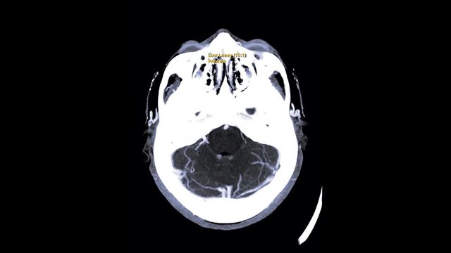 CTA Brain or computed tomography angiography of the brain axial mip view showing common carotid artery  on the screen.