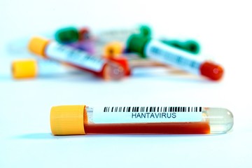Blood test tubes for coronavirus. - 334231344