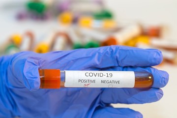 The attendant holds the blood test tube in his hand for corovirus. - 334233135