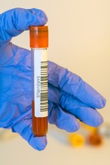 The attendant holds the blood test tube in his hand for corovirus. - 334233731