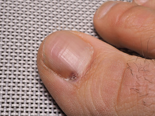 Fototapeta premium Nail infections caused by fungi such as: onychomycosis caused by dermatophytes and yeasts and for the concomitant antibacterial activity