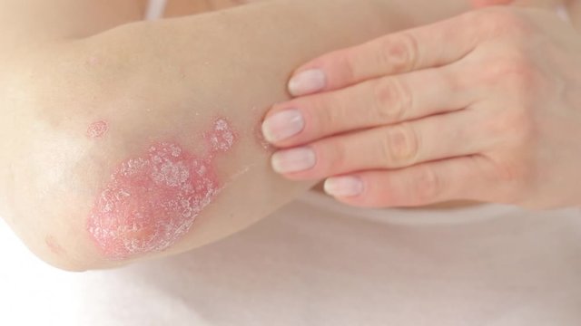 Woman applying anti-inflammatory medicine for corticosteroids for psoriasis. Application of a therapeutic ointment to calm the plurito on the elbow.Treatment of skin diseases - psoriasis, eczema