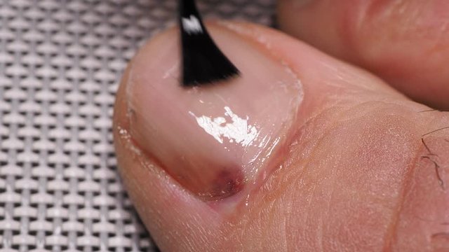 Application of nail solution with brush. Nail infections caused by fungi such as: onychomycosis caused by dermatophytes and yeasts and for the concomitant antibacterial activity. Close up
