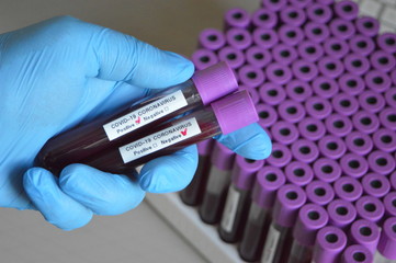 Positive and negative blood test result for the Coronavirus Covid-19
