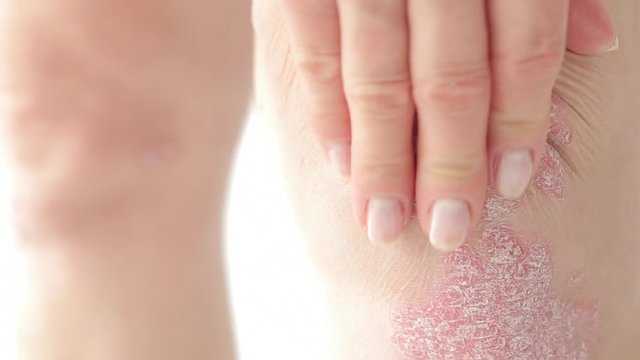 Female hands scratch acute psoriasis on the knees, which is an incurable autoimmune dermatological skin disease.