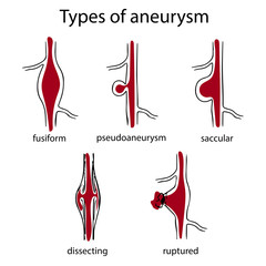 Types of aneurysm. Fusiform, pseudoaneurysm, saccular, dissecting, ruptured. Simple medical anatomy illustration.