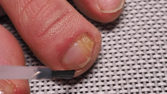 Application of nail solution with brush. Nail infections caused by fungi such as: onychomycosis caused by dermatophytes and yeasts and for the concomitant antibacterial activity. Close up