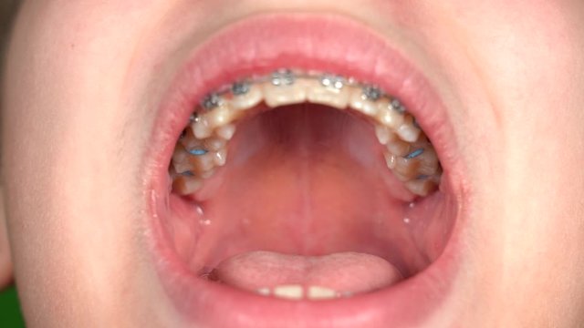 Closeup view 4k video of opened mouth of white kid with overbite white teeth and metal modern braces on them. 
