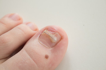 Ingrown toenail treatment. The results of drugs for the treatment of fungal infections and ingrown...