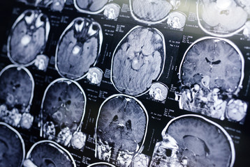 MRI (magnetic resonance image) scan of a patient with a tumor in the brain stem. Neurosurgery, cancer, surgery.