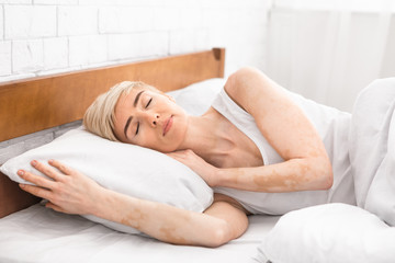 Portrait of mature sleeping lady with vitiligo disease