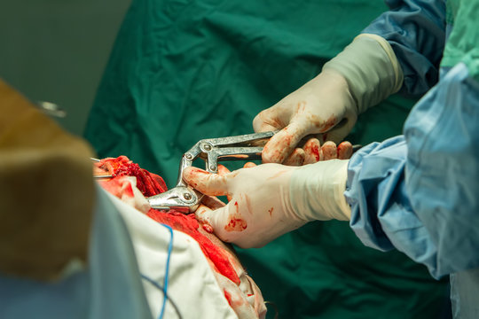 Close-up Of The Hands Of A Surgeon Using Ticks To Break A Skull During A Head Operation ..