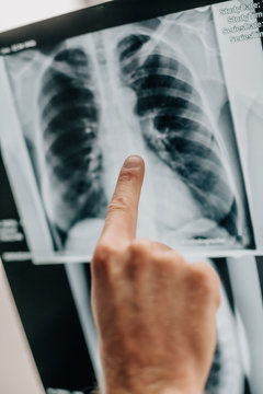 Arzt untersucht Patientin mit Lungenproblemen und schaut das Röntgenbild einer gesunden Lunge an. PS: Foto wurde vor Corona Krise fotografiert.