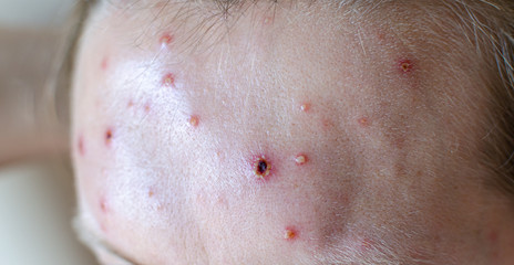 Large spots and pimples acne on the body - adult body with chickenpox. man with Chickenpox, Varicella, Varicella Zoster Virus.