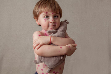 ,boy with chickenpox. Sick child with chickenpox. Varicella virus or Chickenpox bubble rash on...