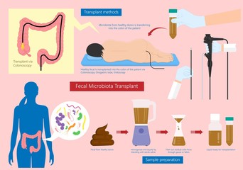 Fecal microbiota transplant (FMT) stool transferring bacteria microbes  - obrazy, fototapety, plakaty