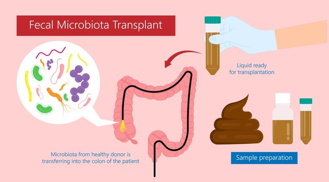 Fecal Microbiota Transplant (FMT) Stool Transferring Bacteria Microbes 