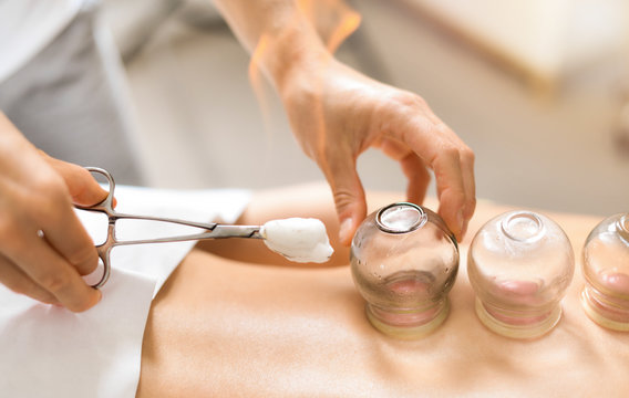 Detail Of A Woman Therapist Hands Giving Cupping Treatment On Back.