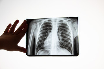 X-ray of a person s lungs with a disease. Screening for coronavirus viruses