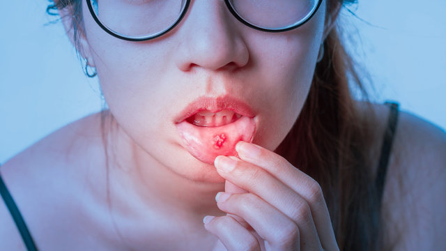 Asian women have aphthous ulcers on mouth, selective focus.