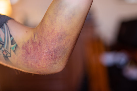 Intense bruising from a dislocated elbow joint and ligament damage on man. The bruise is approximately two weeks old and starting to recede.