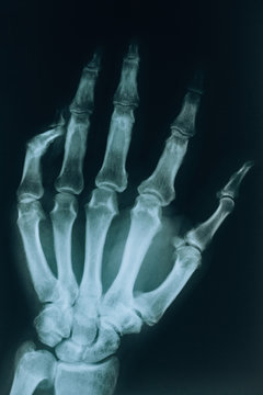 X-ray of the hand. A real x-ray of the human hand, fingers and bones. Finger injury