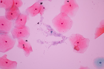 View in microscopic of Candidiasis, fungus infection (Yeast and Pseudohyphae form) in pap smear...
